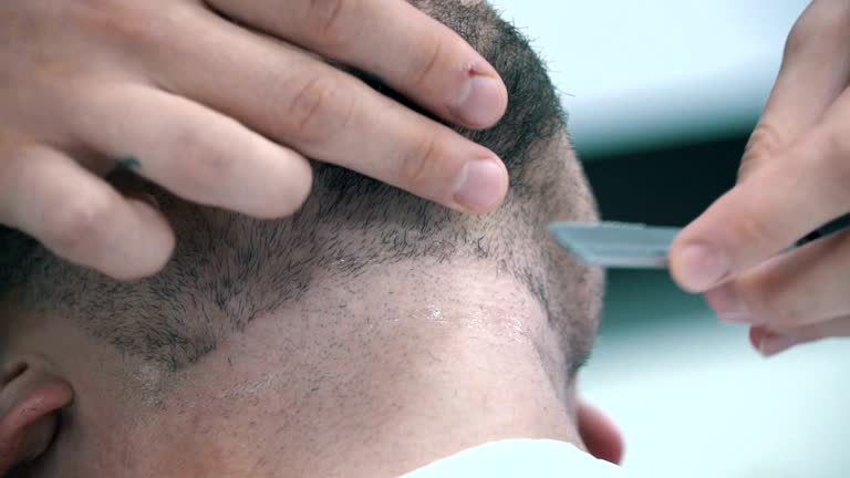 Aujourd’hui, de plus en plus de jeunes s’interrogent sur la GREFFE DE CHEVEUX. En effet, la perte de cheveux précoce touche