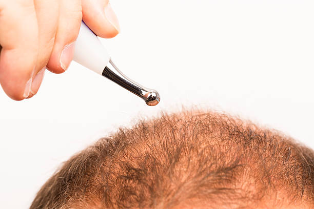 La greffe de cheveux par FUT repose sur un prélèvement de bandelette. Ensuite, cette bandelette est découpée en greffons.