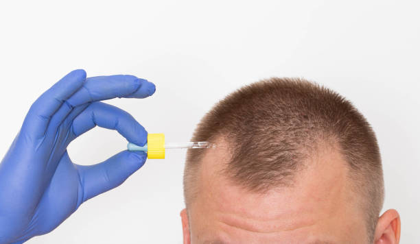 La technique FUT, ou Follicular Unit Transplantation, est une méthode de GREFFE DE CHEVEUX très répandue. En effet,