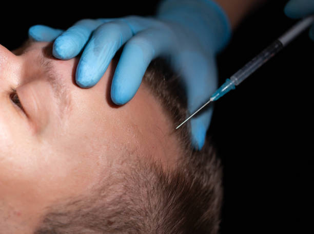 La FUT, ou Follicular Unit Transplantation, reste une technique classique de GREFFE DE CHEVEUX. En effet, elle consiste à prélever