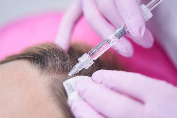 Après une GREFFE DE CHEVEUX par FUT, le nettoyage est crucial. En effet, la zone donneuse a subi une incision. Par conséquent,