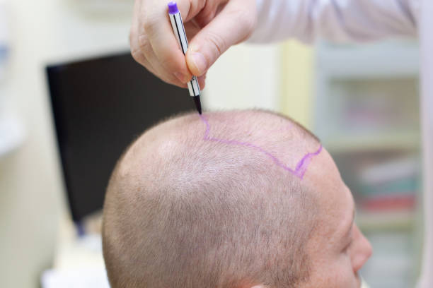 La GREFFE DE CHEVEUX est une solution efficace contre la calvitie. Par ailleurs, la technique FUT (Follicular Unit Transplantation)