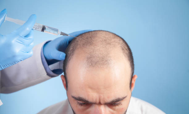 La GREFFE DE CHEVEUX est une solution populaire contre la calvitie. Cependant, elle comporte des risques spécifiques.