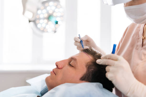 La zone donneuse est la base de toute greffe capillaire réussie. En effet, c’est ici que les follicules sont prélevés. Par conséquent,