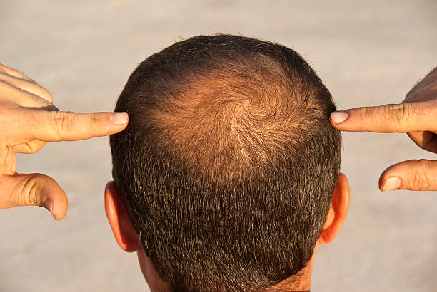Teindre ses cheveux est un geste courant. Toutefois, après une greffe capillaire, il faut redoubler de prudence. En effet,