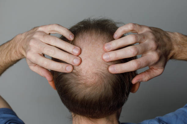 L’activité physique après une greffe soulève de nombreuses questions. En effet, beaucoup de patients hésitent. Pourtant,