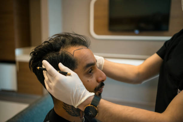Après une greffe de cheveux, la patience est essentielle. En effet, le cuir chevelu reste sensible durant plusieurs jours. De ce fait,