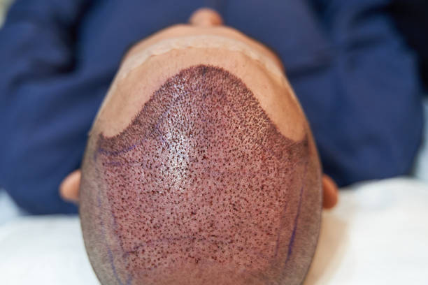 La greffe FUE est une technique moderne de restauration capillaire. En effet, elle consiste à extraire individuellement des follicules.