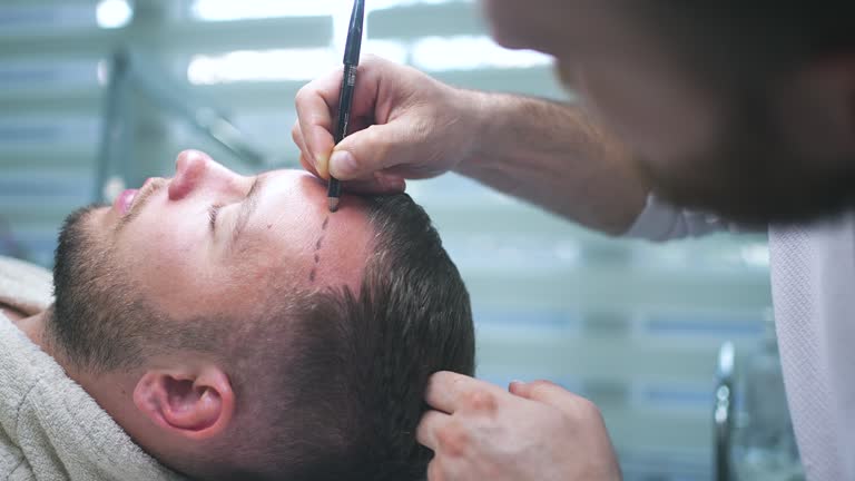 Une greffe FUE consiste à prélever des follicules capillaires un par un. Ainsi, le chirurgien les implante ensuite dans les zones